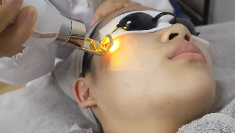 carbon lazer
