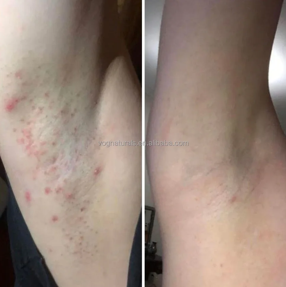 De La Vello Enterrado En Axila Piel Vello Encarnado En Las Axilas