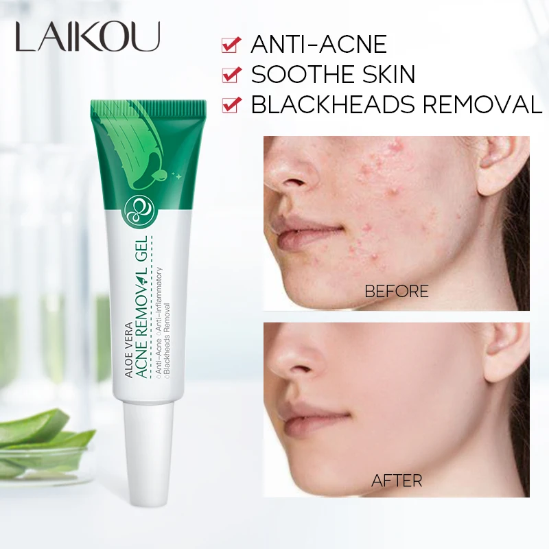 Natural Aloe Vera Gel Pimple Scar Anti Acne Cream Repairing Smoothing  Hydrating Anti Acne Gel| Alibaba.com