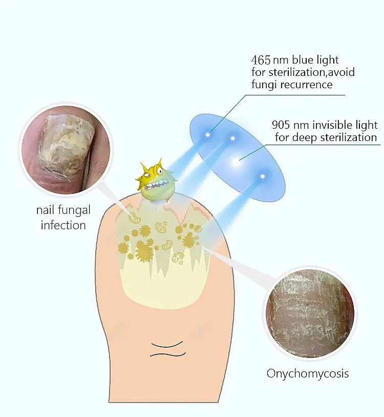 Nail Fungal Infection Therapy Device