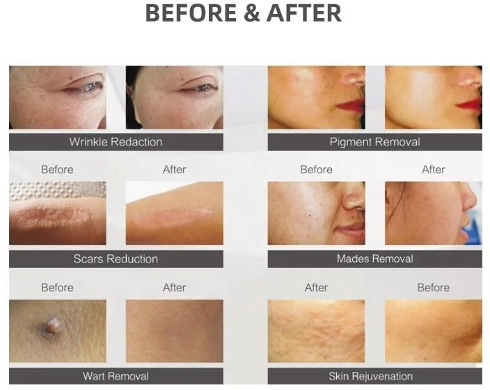 2026 Professional Fractional CO2 Laser 10600nm Skin Resurfacing Machine Beauty Equipment Wrinkle Removal Skin Tightening Salon