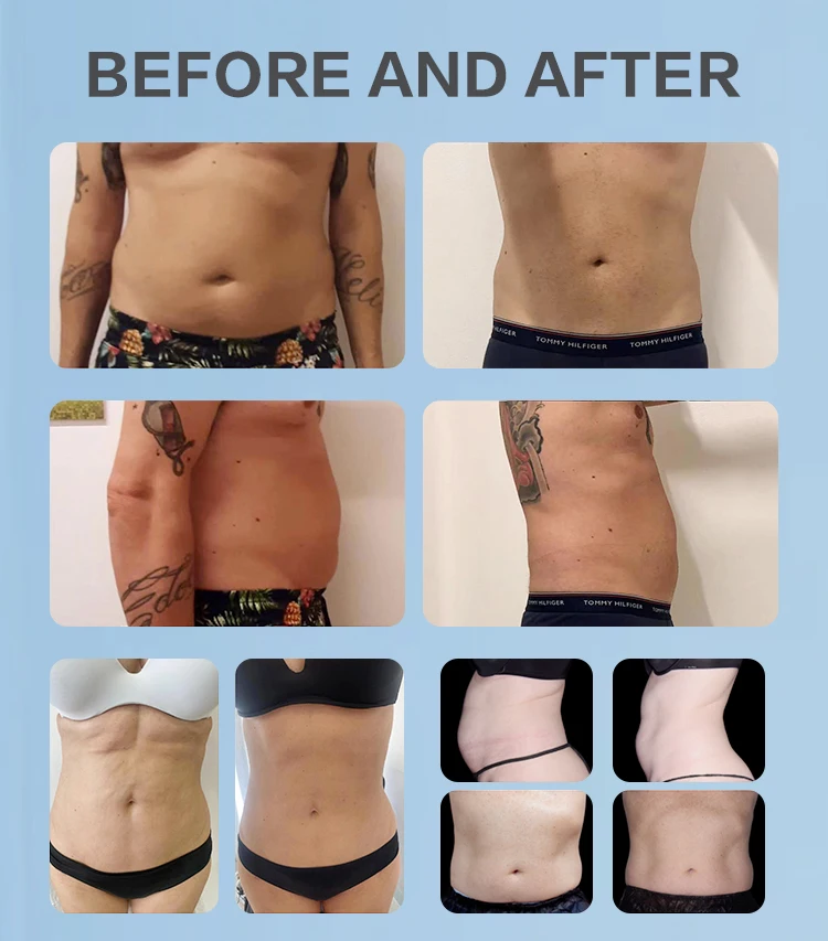 Apolomed Ems Slim Machine for Muscle Stimulation and Slimming details