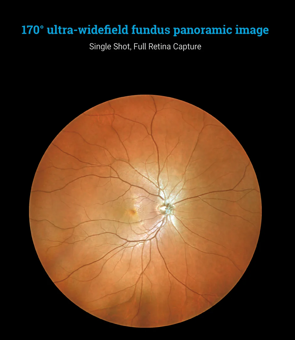 170&deg; Ultra Wide Field Fundus Imaging System Retinal Camera with Four Laser Sources and Automatic Eye Positioning