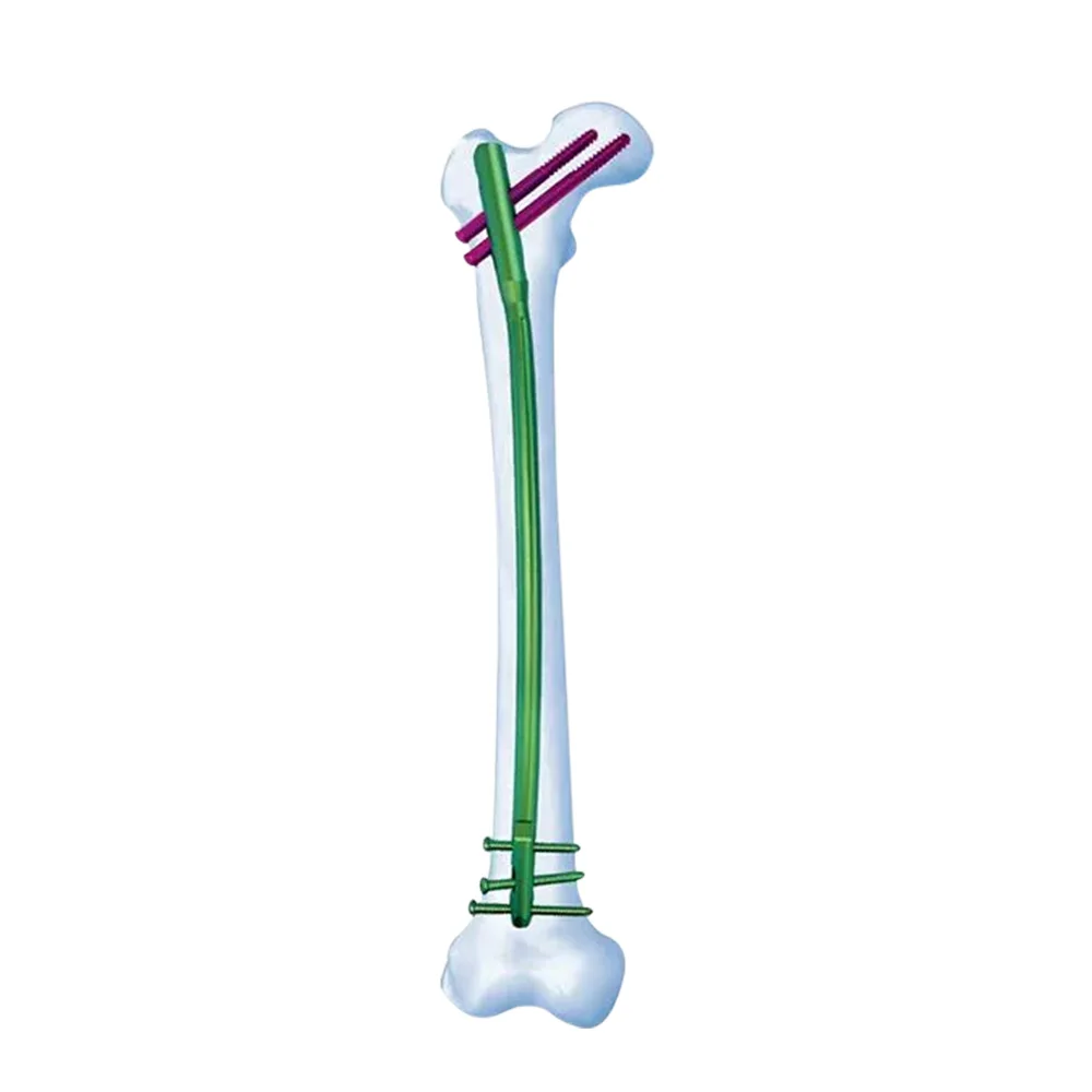 Femoral Nail