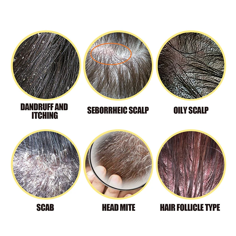 new arrival anti dandruff itchy restore damage hair repair scalp care treatment sulfur massage shampoo