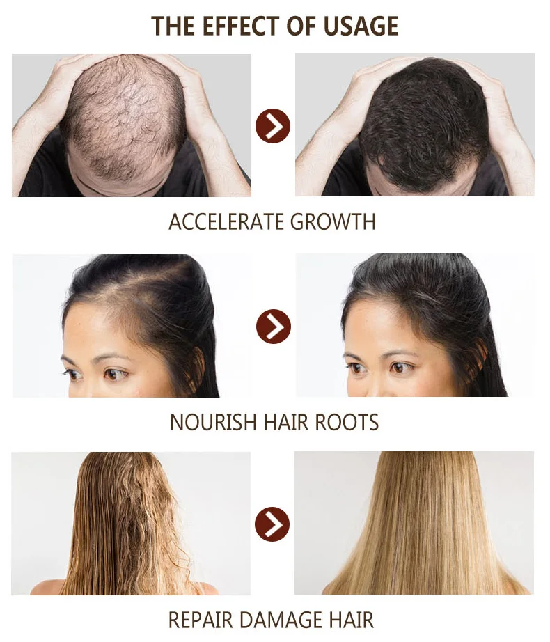 Natural Pure Hair Growth Essential Oil Ginger Hair Growth Oil 30ml