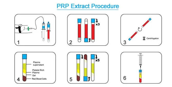 PRP PROCEDURE