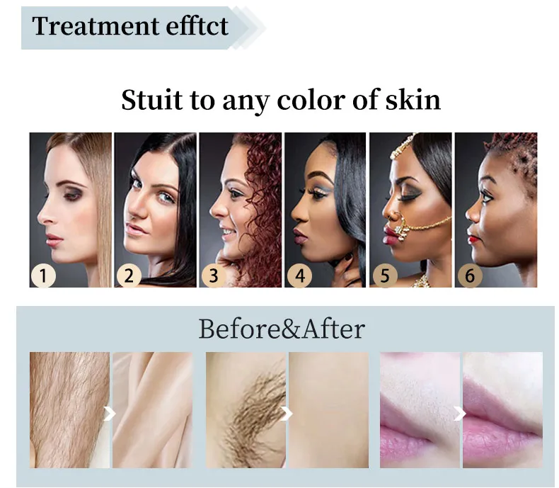 Approved Portable 808nm Diode Laser Permanent Hair Removal Machine 2000W Air Cooling Home Use UK Plug Spare Parts Repair
