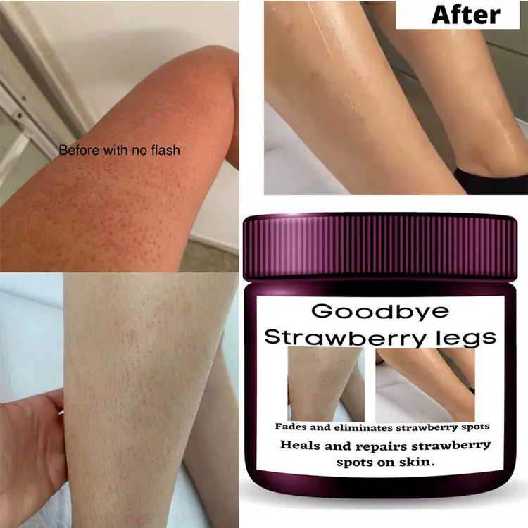 7 Days Whitening Strawberry Legs Cream Fades Strawberry Spots Skin