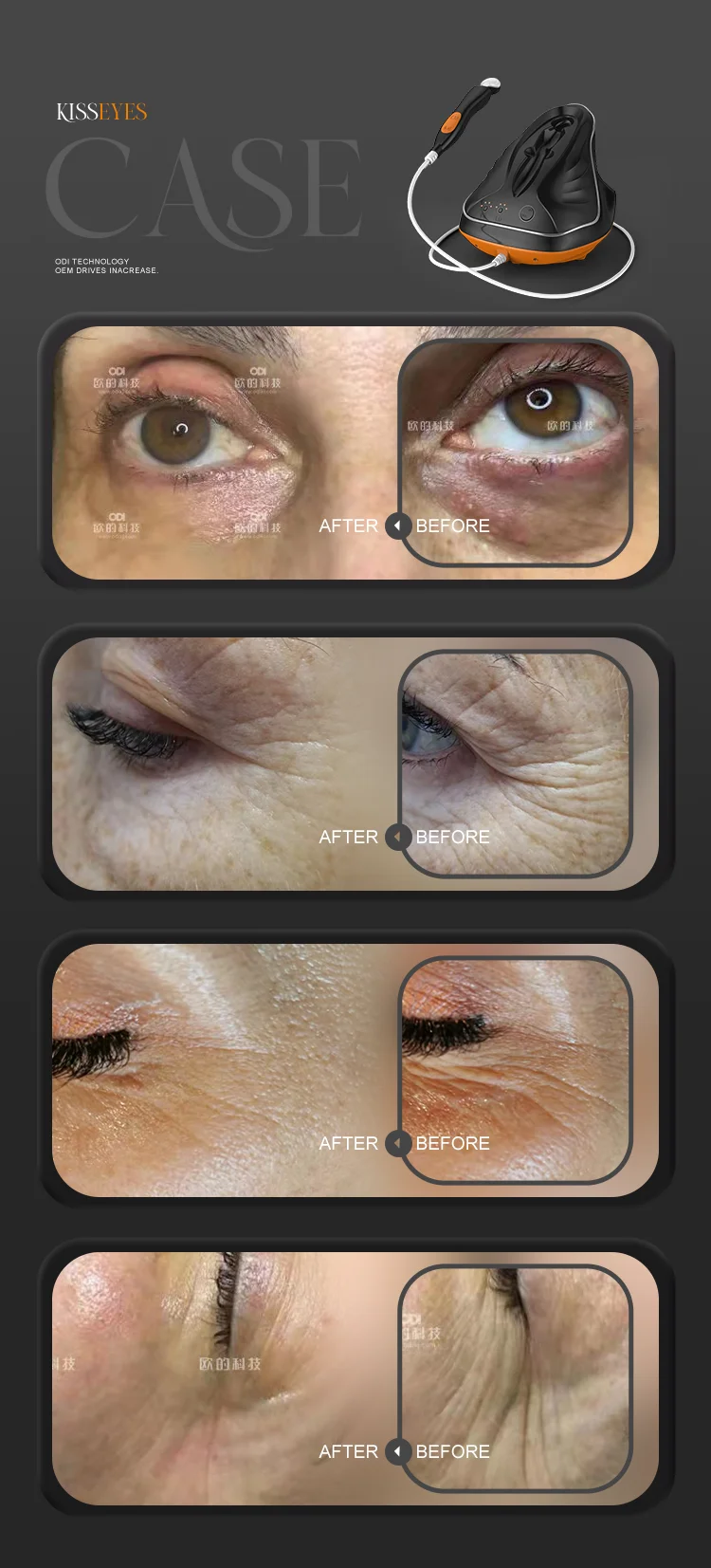 face lifting skin tightening rf eye care equipment multifuctional radio frequency eye beauty device instrument