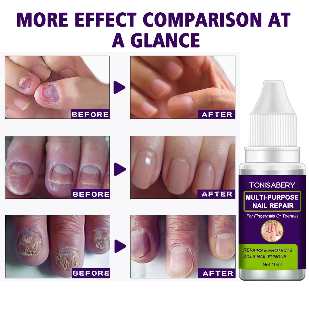 Regenerate Your Nails With 10 Ml Of Grey Nail Restoration Solution Buy Fungal Nail Treatments