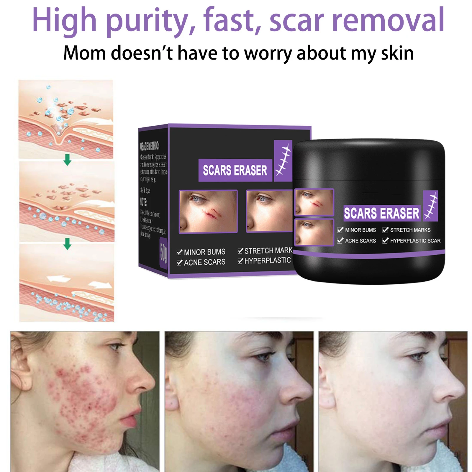 Treatment From Keloid Scars Scar Stain Remover Cream For Scars On Legs ...