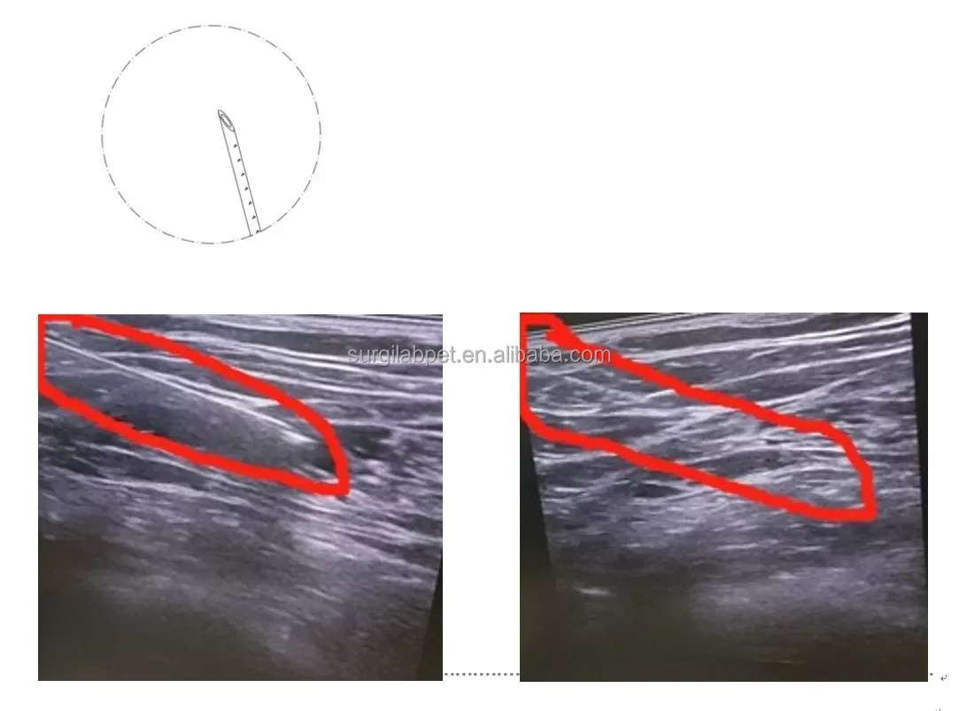 Disposable Peripheral Nerve Block Needle Catheter With Ultrasound