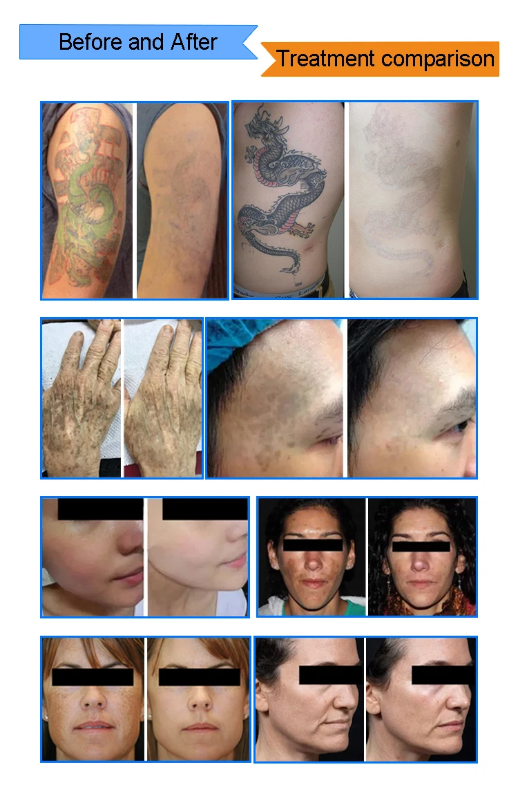 Korean Articulated Arm APOLOMED Clinic Picolaser Medical Pico Laser Picosecond Q Switched Nd Yag Laser Tattoo Laser Removal details
