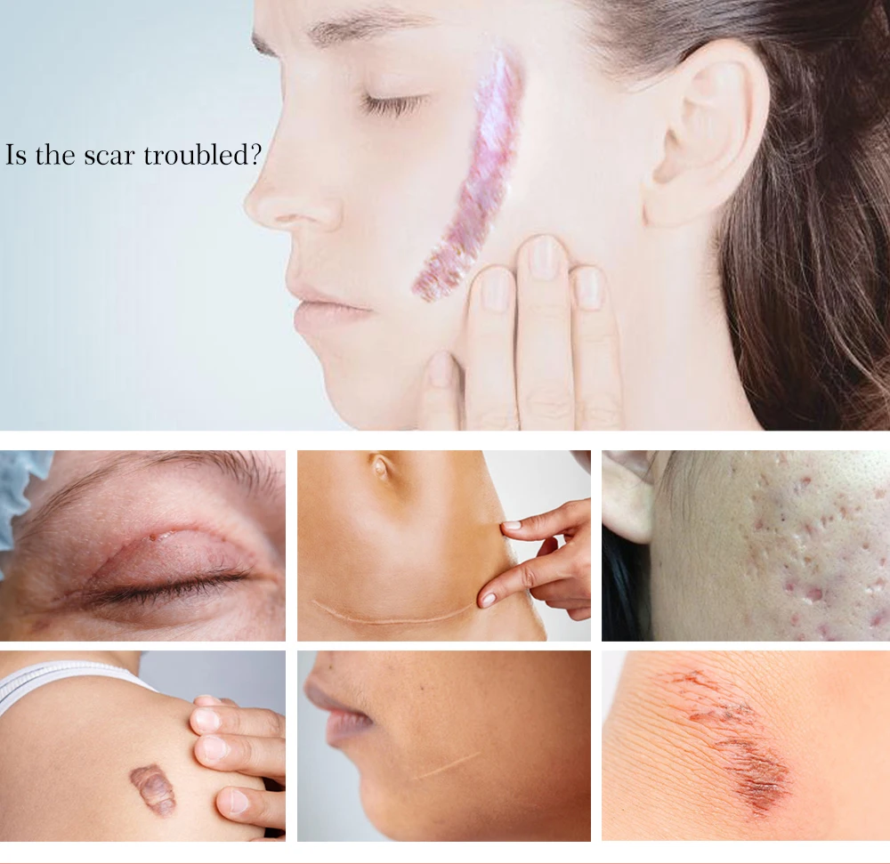 Yoxier Lavender Herbal Scar Repair Cream Pigment Correction Smooth Skin Whitening Scar Care  Fast Repair  Comfort Care in Stock