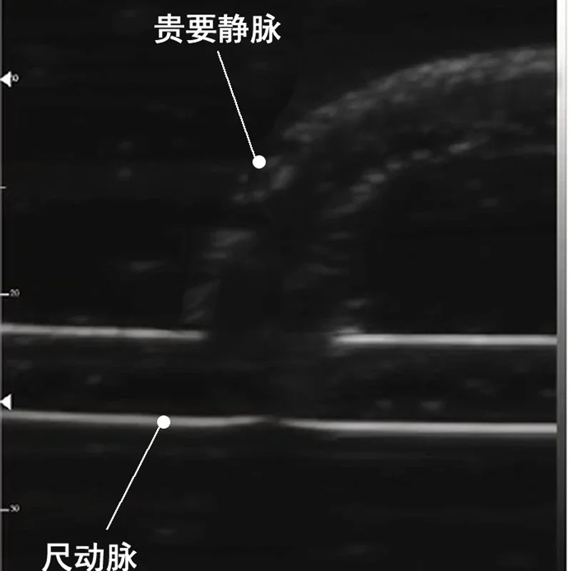 B-ultrasound Arteriovenous Fistula Training Model for Percutaneous Transluminal Angioplasty (PTA)