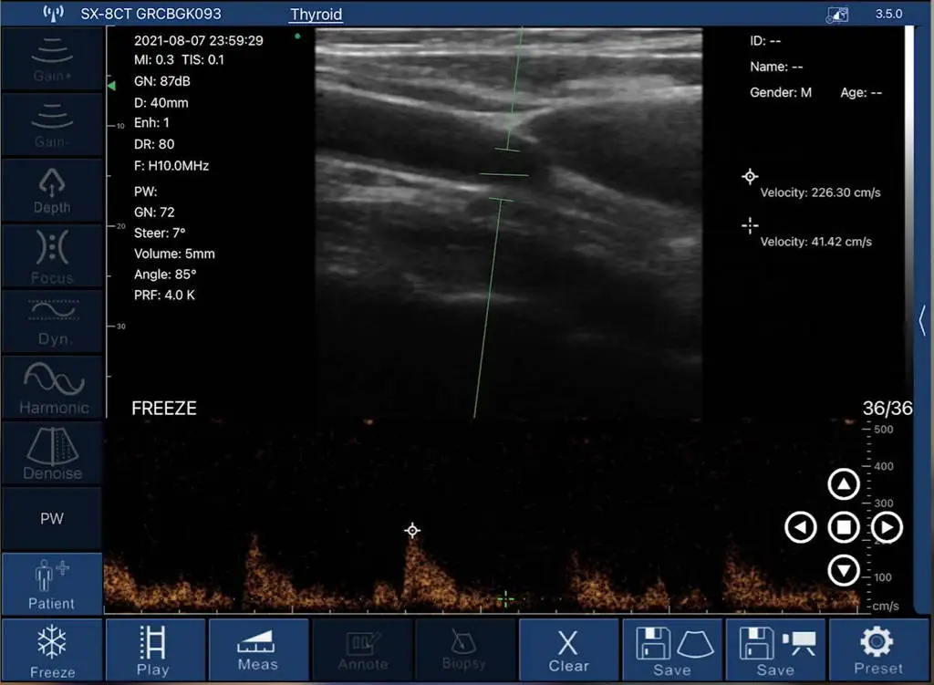 Viatom Probe Wireless Digital Ultrasound Scanner Portable Ultrasound Machine