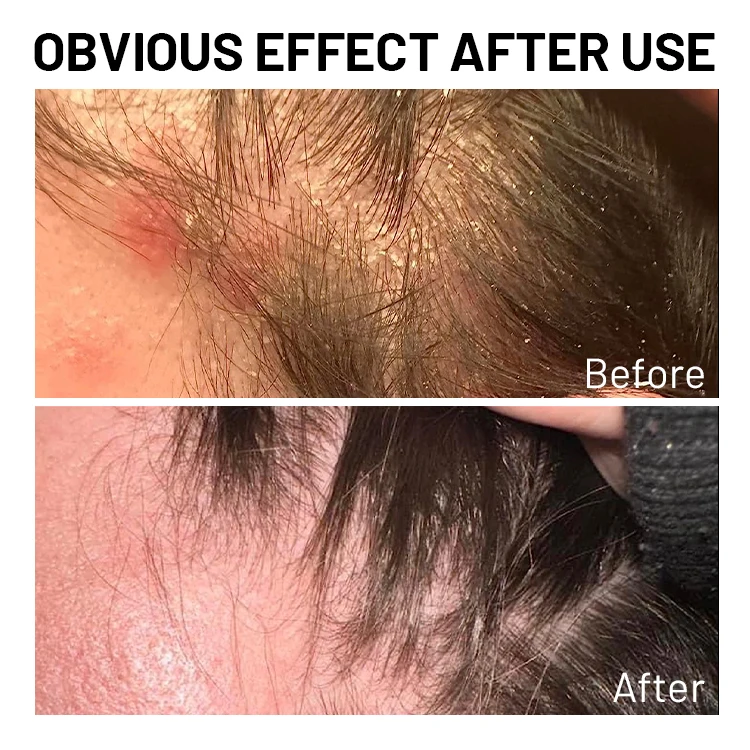 Private Label Nourishing Antifungal Tea Tree Oil Shampoo for Scalp Psoriasis Folliculitis Seborrheic Dermatitis Effective