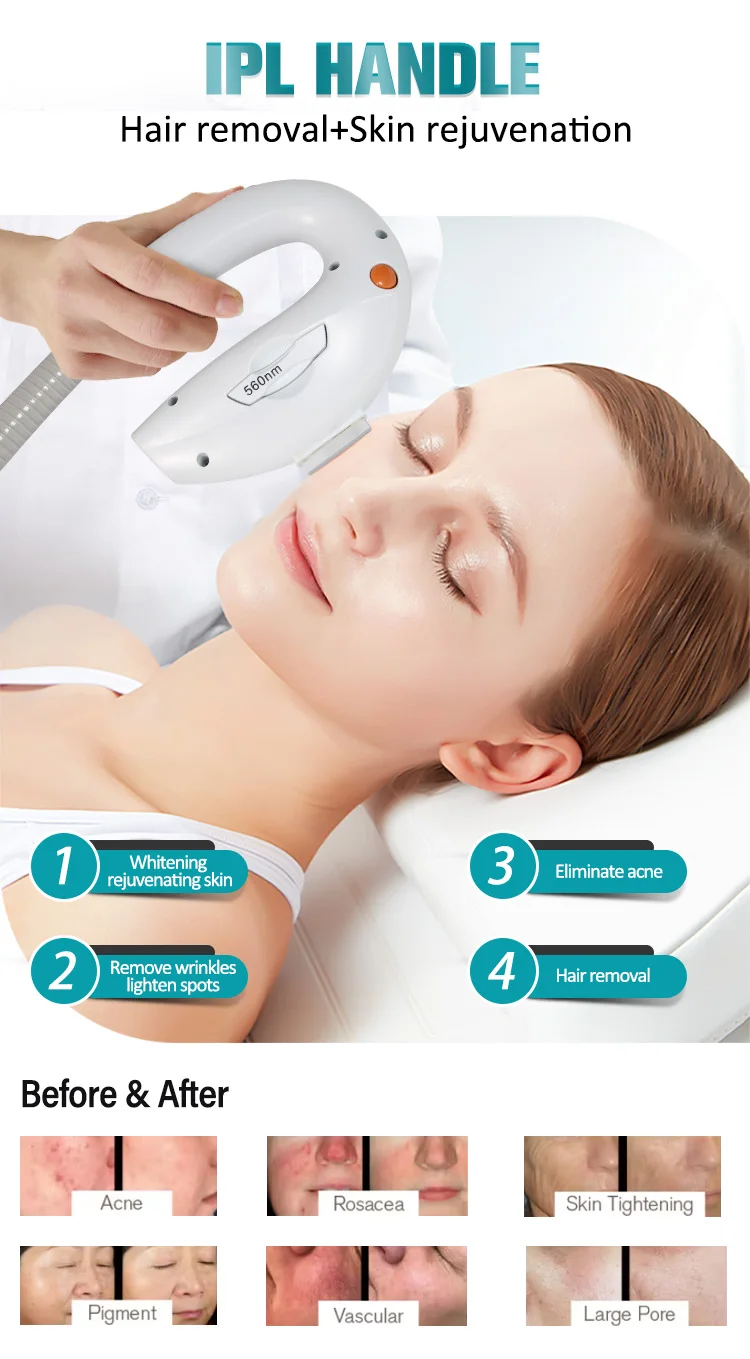 Portable 2 in 1 Q-SWITCH Tattoo Removal Carbon Peeling Skin Whitening Machine/ Fast IPL Hair Removal Machine