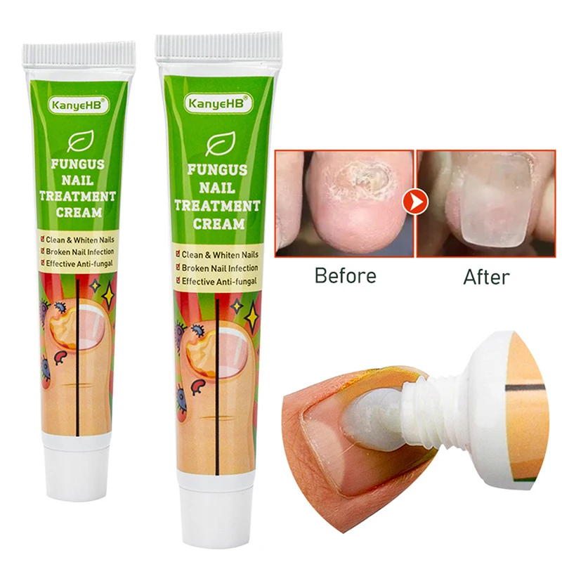 Sumifun мазь от грибка ногтей. Sumifun мазь от грибка ногтей. Fungus treatment cream. Fungus treatment cream. Лимфотоники препараты для ног.