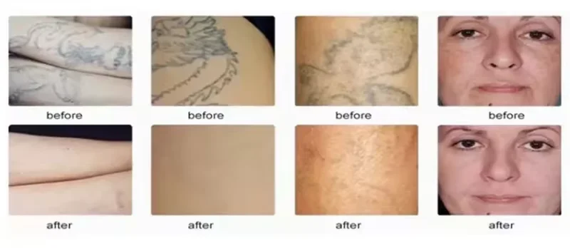 Hot sell Mini eyebrow washing machine nd yag pico laser tattoo removal pico machine