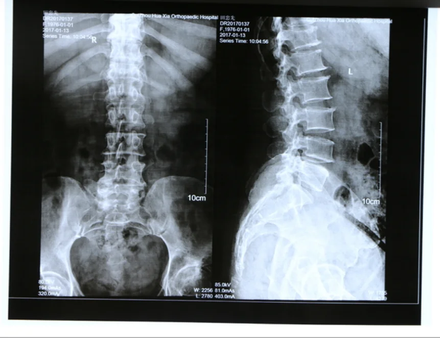 Factory Price Medical X Ray Films CR DR CT MRI PET X Ray Film 10x12 11x14