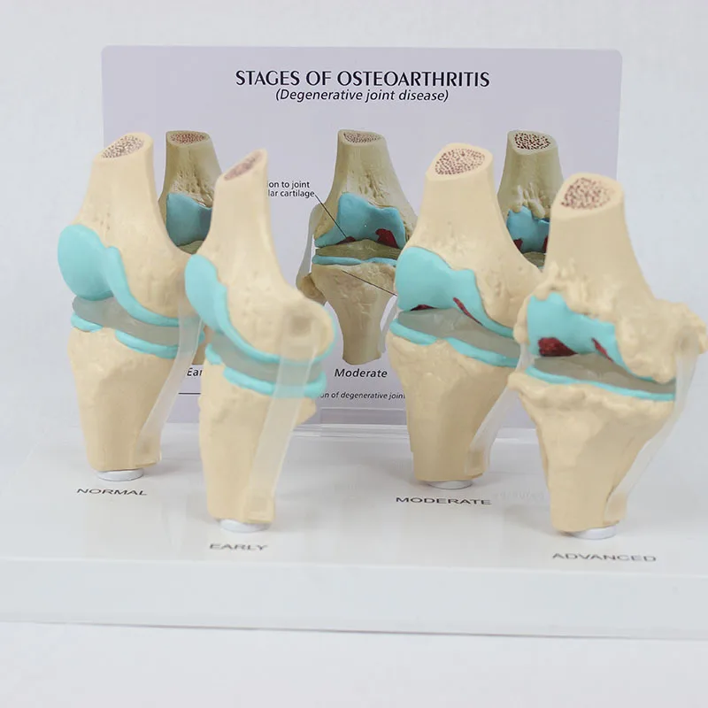 4 Stage Knee Joint Disease Model - Anatomy Teaching Tool
