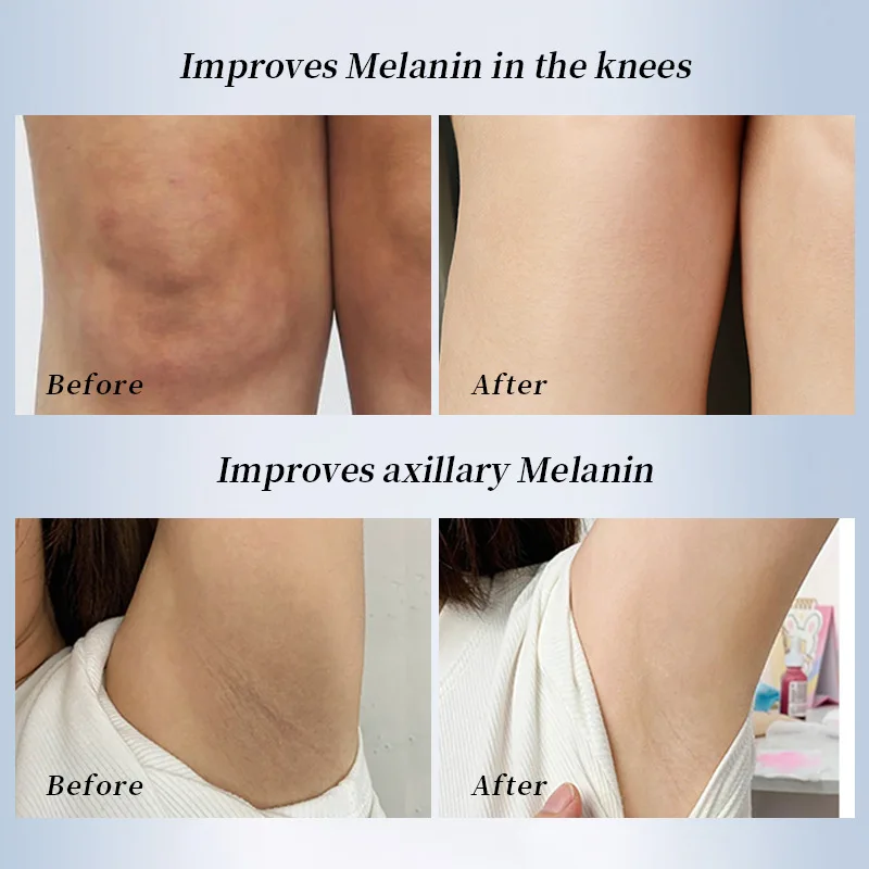 Axilas Oscuras Laser Para Manchas En Axilas Manchas Oscuras La