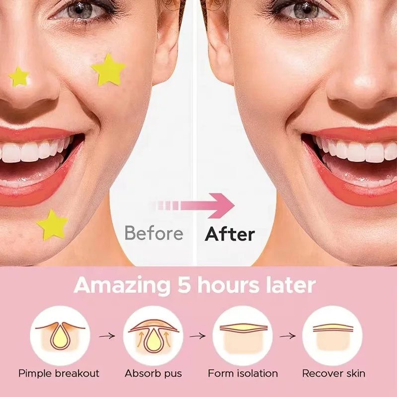 PDANY Customized Pimple Patches for Face Hydrocolloid Acne Pimple Patch Skin Care Covering Zits and Blemishes Spot Stickers