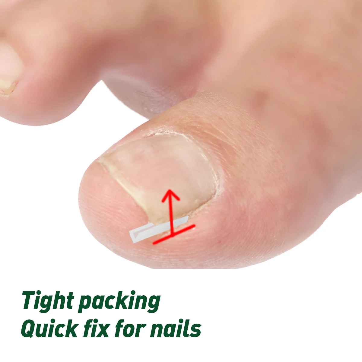 Stainless Steel Toenail Correction Pedicure Tool For Nail Recover Foot