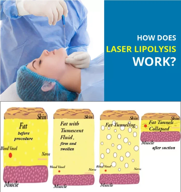 Effective Result Laser Lipolysis Liposuction Machine Plastic Surgery