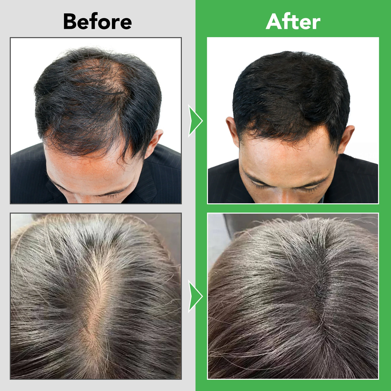 Oem 100 Pure Natural Organic Rogaine Hair Growth Care Set Antihair