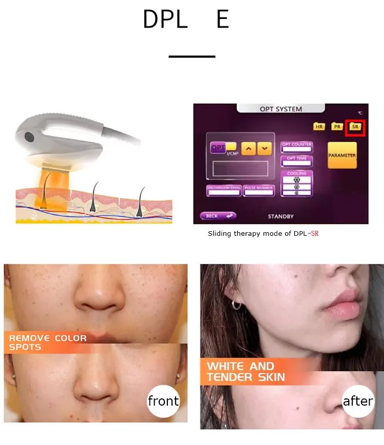 Professional DPL & IPL Photon E-Light Beauty Device NdYag Laser for Skin Rejuvenation & Hair Removal