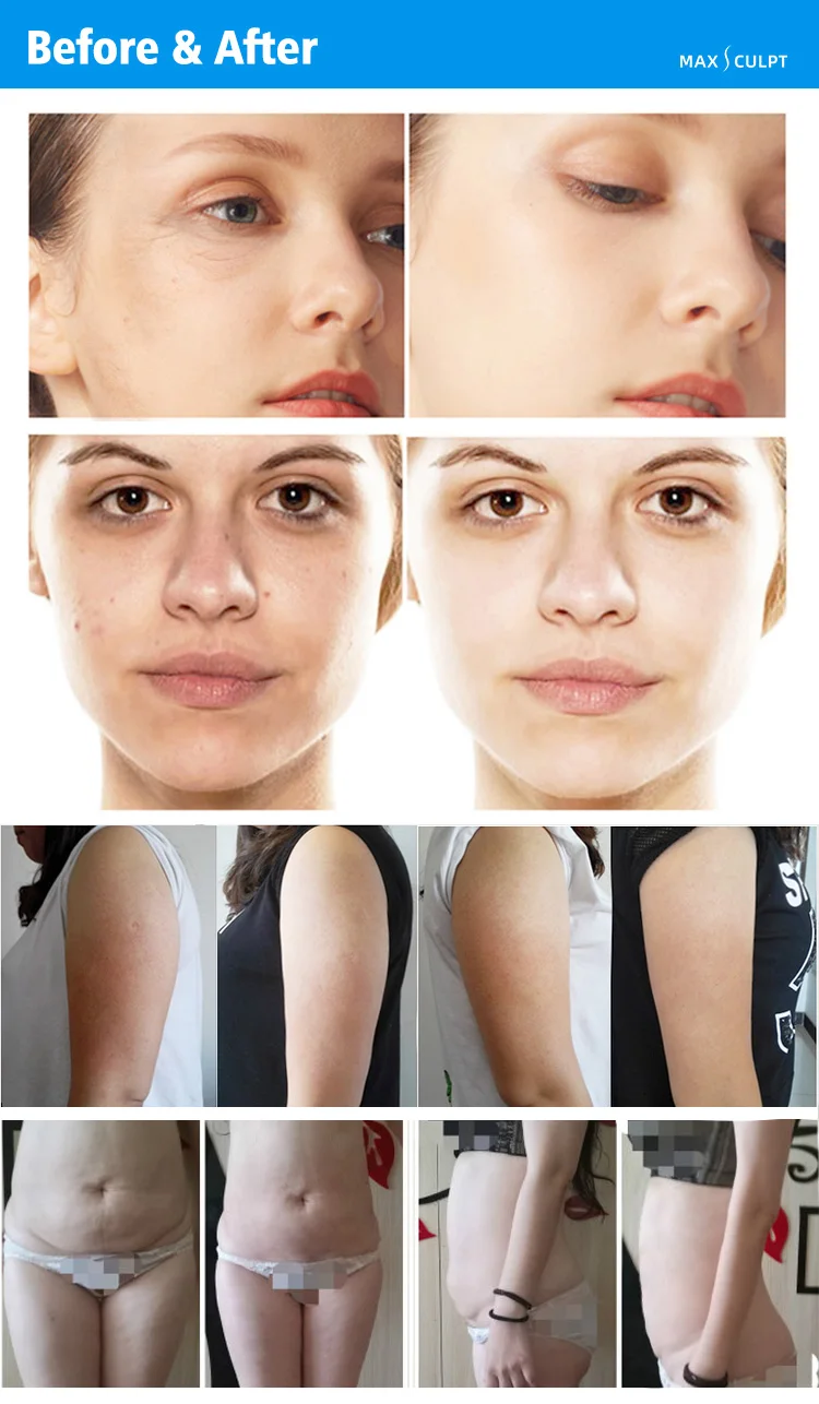 Professional Cellulite Removal Machine 40kHz Cavitation Vacuum Cavitation System Lymphatic Drainage 360-Degree Roller Hands