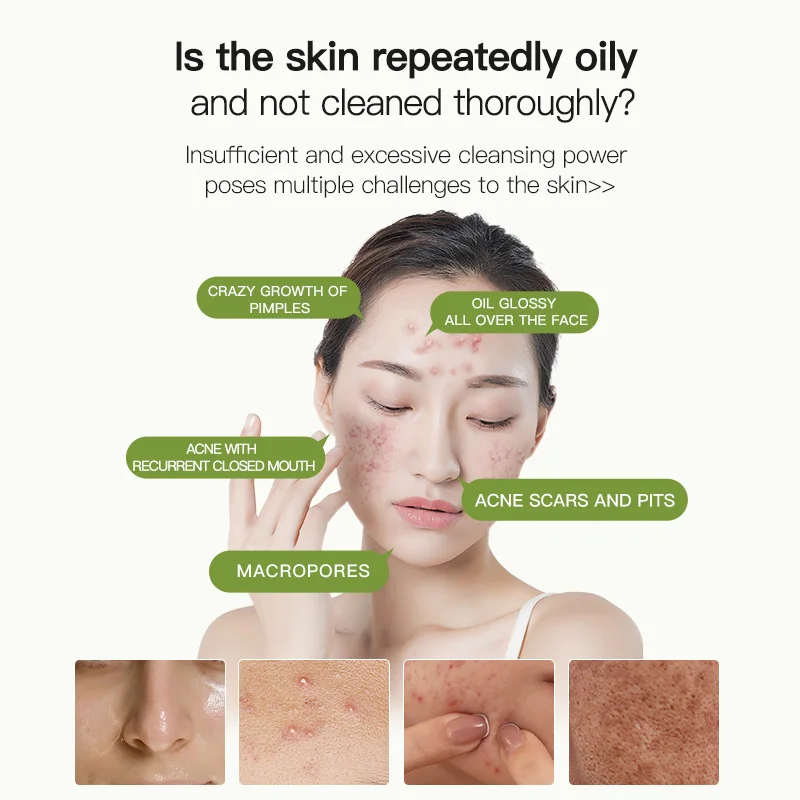 Icesea Tea Tree Oil Purifying Essence Lotion- Daily Acne Treatment Oil Control Pore Minimizing Face Moisturizer(pic3)