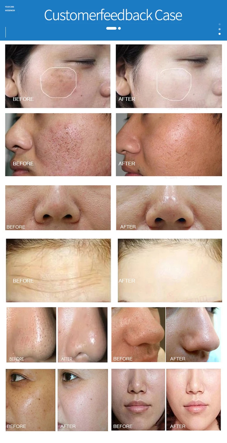 Oxygen Hydrafacial Beauty Machine Exfoliating Blackheads Ultrasonic Skin Scrubber