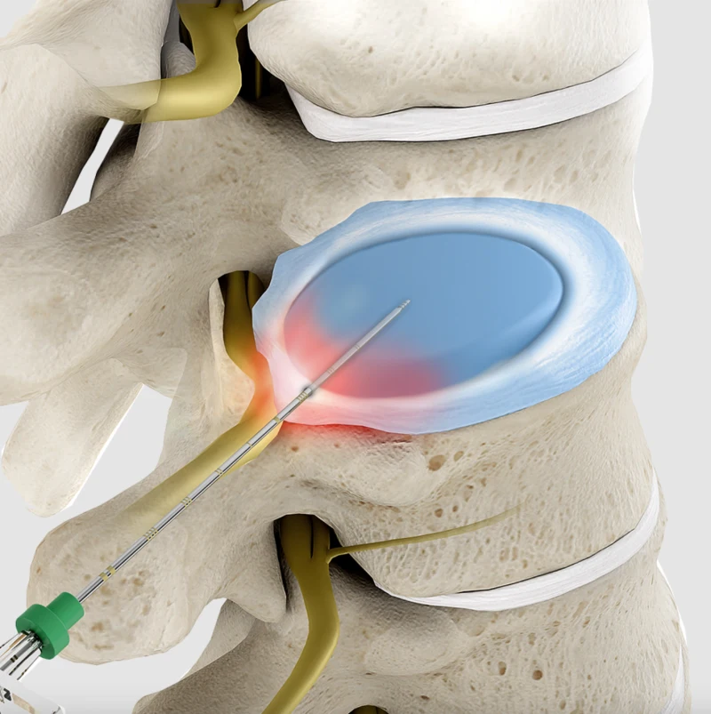 Laser Saraf Kejepit (PLDD)