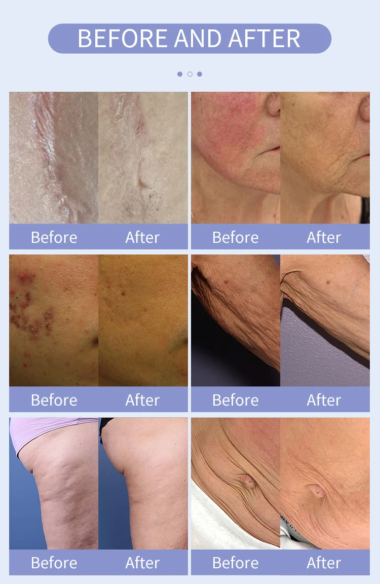 Discover a clinical-grade Microneedling RF System engineered for deep dermal remodeling, collagen stimulation, acne scar reduction, and skin tightening. Adjustable depth up to 7mm with precision RF delivery. Professional Fractional RF Microneedling Machine For Sale