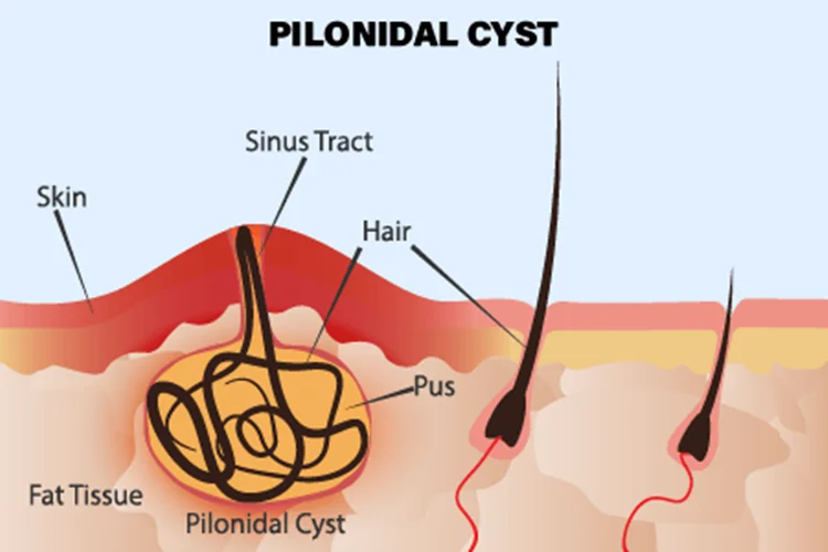 pilonidal-cyst