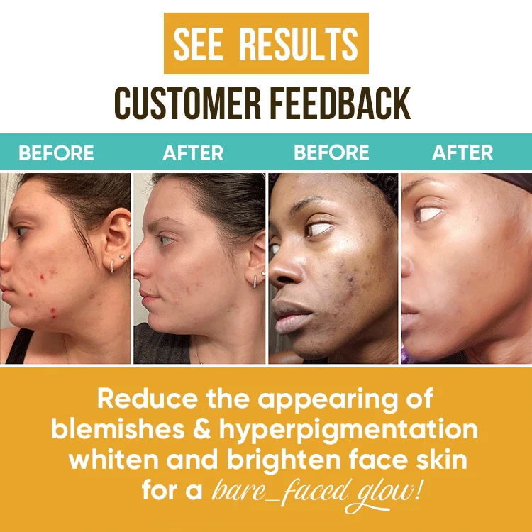 High Class Whitening Ance Help Cosmetic Set  Turmeric Soap Turmeric Serum  Turmeric Lotion