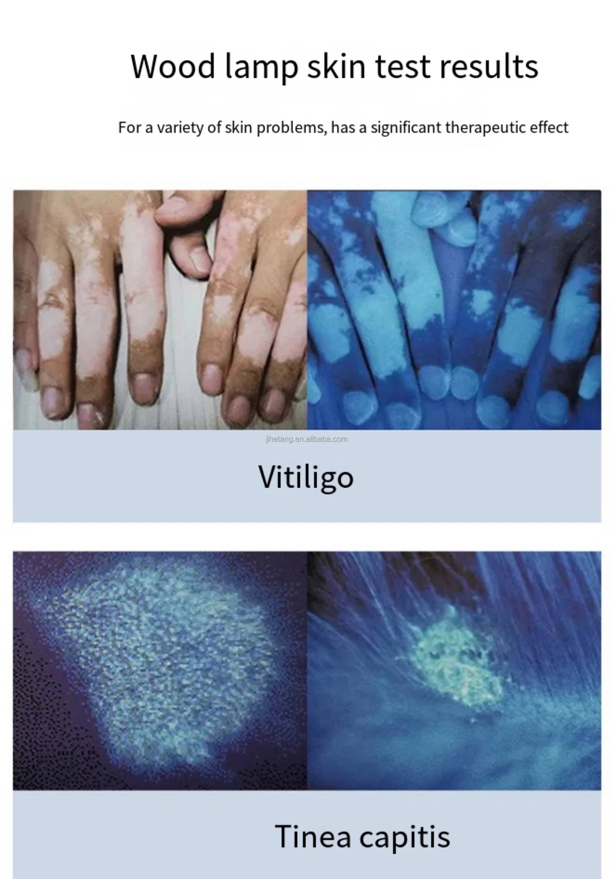 365nm Long Wave UV Acne Tinea Capitis Melasma Amyloid Plaques Vitiligo Psoriasis Animal