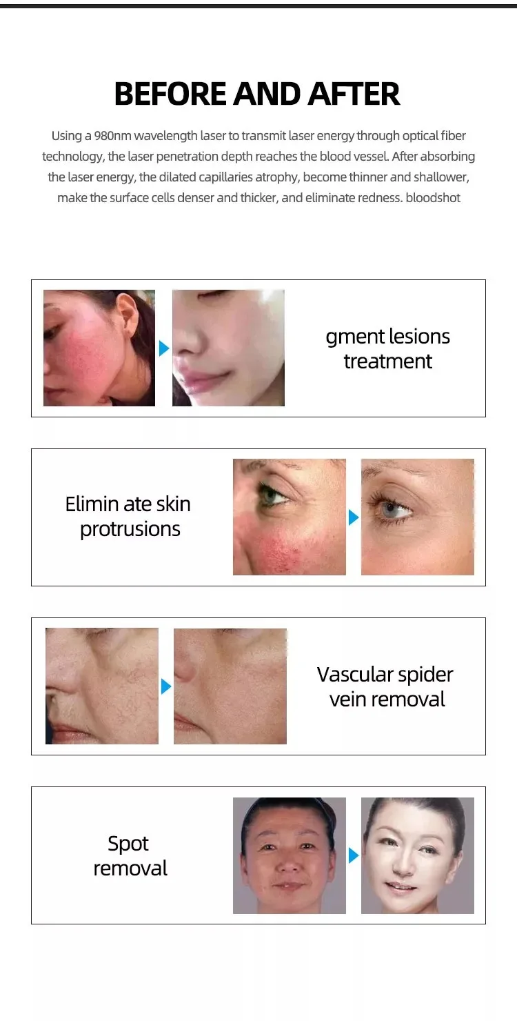 <p data-start="342" data-end="622">High-performance 980nm Diode Laser 2-in-1 machine for precise vascular problem treatment, pain relief and enhanced comfort with integrated cold hammer handpiece. CE-certified portable solution for clinics and beauty salons. Optimize client outcomes with efficient laser therapy.</p> Professional 980nm Diode Laser Vascular Spider Veins Laser Removal Machine