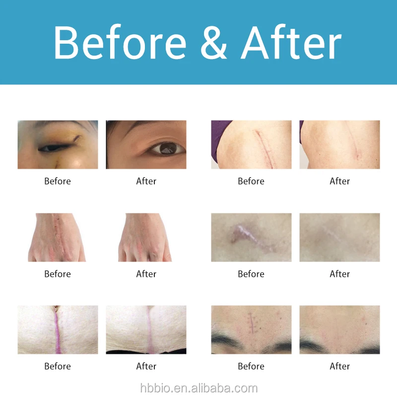 Advanced Formula Powerful Face Treatment Scar Gel Private Label Cream