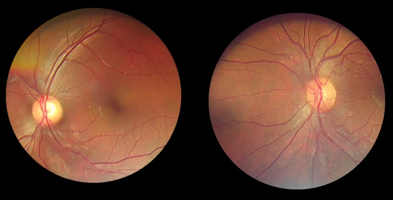 Portable Fundus Camera CFC-X Handheld Eye Fundus Retinal Camera Non-Mydriatic Digital Fundus Camera Ophthalmic Instrument