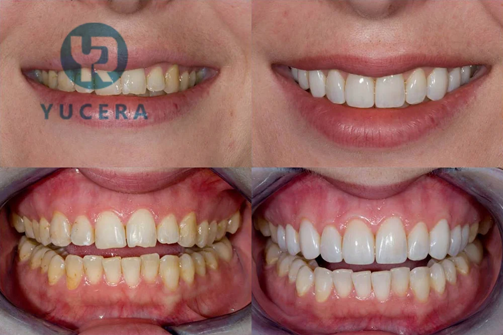 Artificial Teeth Making Material Multilayer Preshaded 4D Pro Zirconia Discs for Open System Cad Cam Zirconia Block