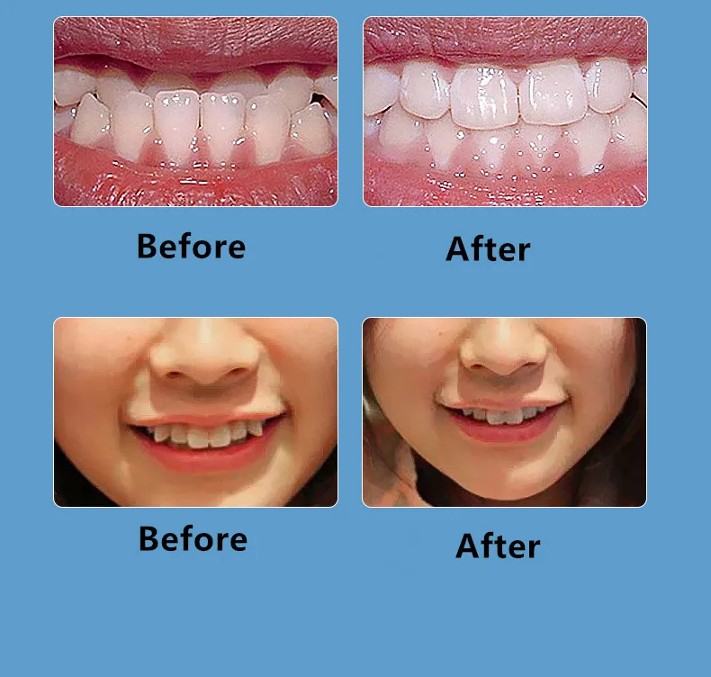 Customized Clear Orthodontic Aligners for Teeth Alignment & Protection ...