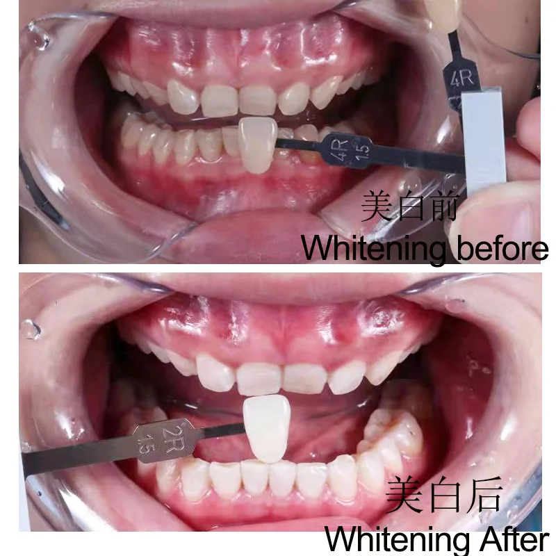 トライアルセット・サンプル Dennovate Teeth Whitening Gel Pack Dennovate Teeth Whitening Gel Pack - メルカリ