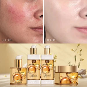 Acne Treatment Products  Collagen Vitamin C Herbal Anti-Wrinkle Organic Whitening Dark Spot Removal Firming Face