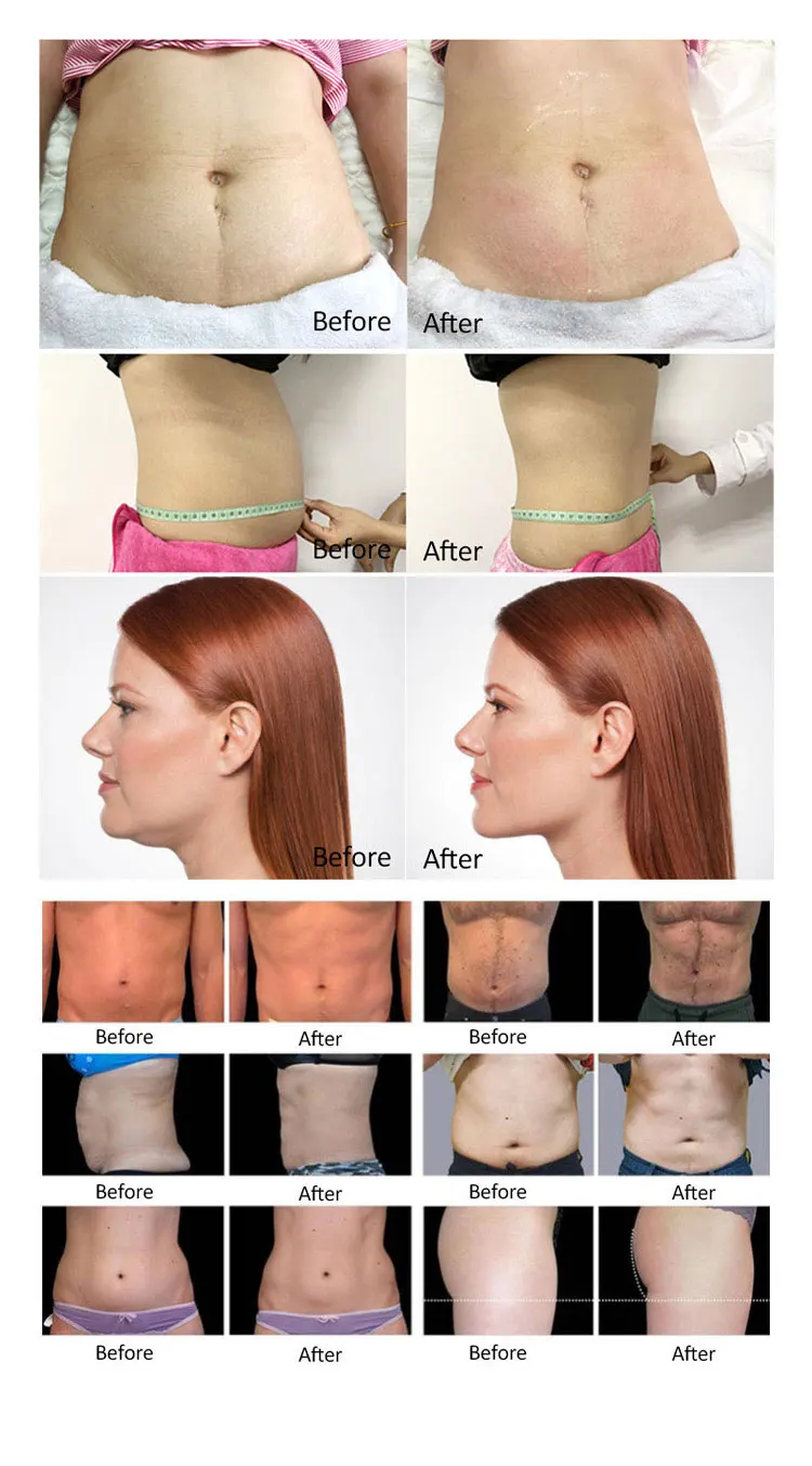 <p data-pm-slice="1 3 []">The Portable Cryo Fat Freezing Machine is designed for professional aesthetic businesses offering targeted body-contouring treatments. Supplied with three interchangeable cryolipolysis applicators, it supports treatment planning for different body areas, from the abdomen and waist to the buttocks, legs, arms and double chin.</p> With three applicator sizes in one compact system, practitioners can select an appropriate handle according to the treatment area and individual client assessment. This versatile configuration makes the machine a practical option for beauty salons, Med Spas and body-contouring studios looking to expand their non-invasive aesthetic service offerings. <strong>Included Applicators:</strong> <ul data-spread="false"> <li>Big Cryo Handle: 17 × 10 cm — abdomen and waist</li> <li>Medium Cryo Handle: 14 × 5.5 cm — buttocks and legs</li> <li>Small Cryo Handle: 8 × 4 cm — double chin and arms</li> </ul> Portable Cryo Fat Freezing Machine with 3 Handles for Professional Body Contouring