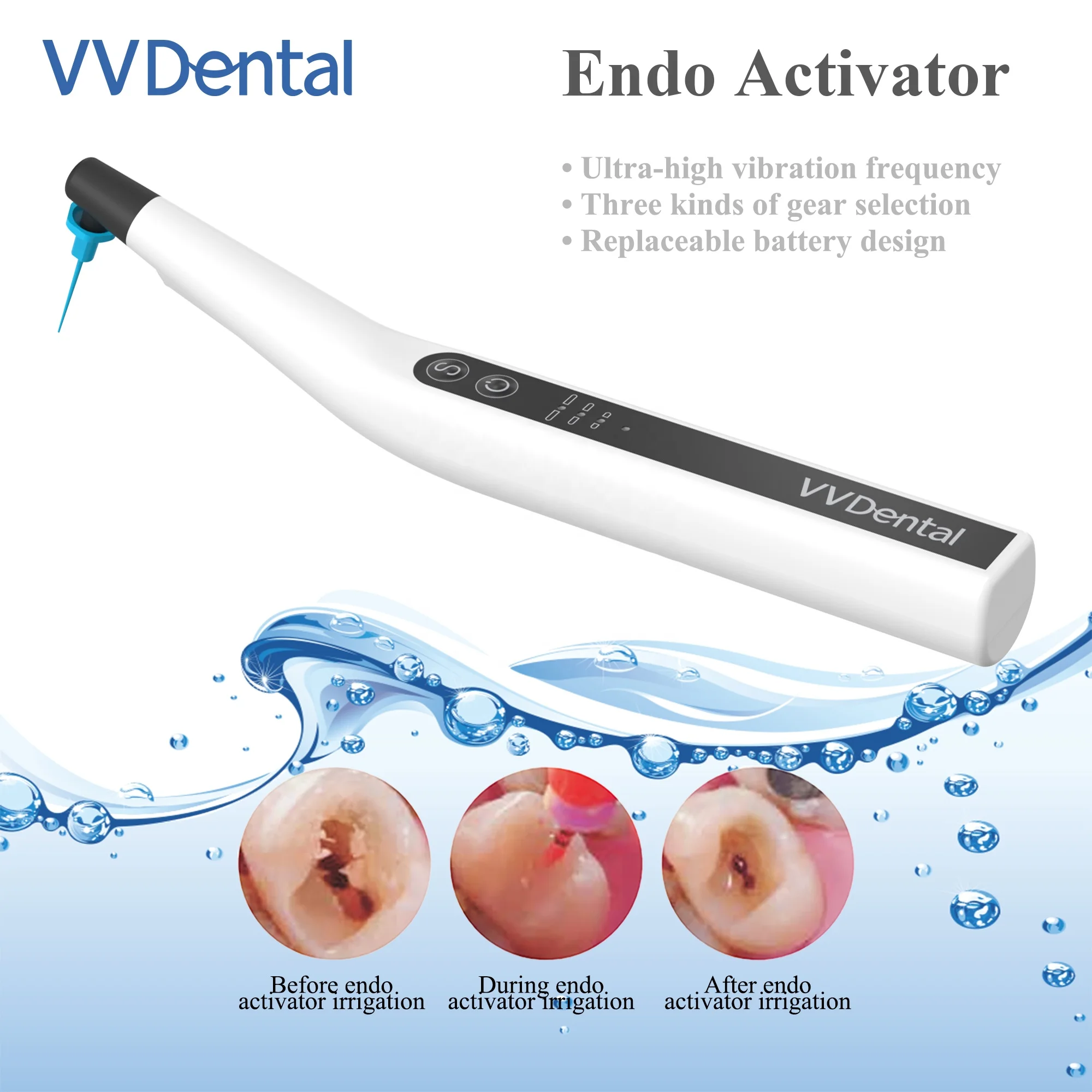 Irrigador de conducto radicular con activador ultrasónico